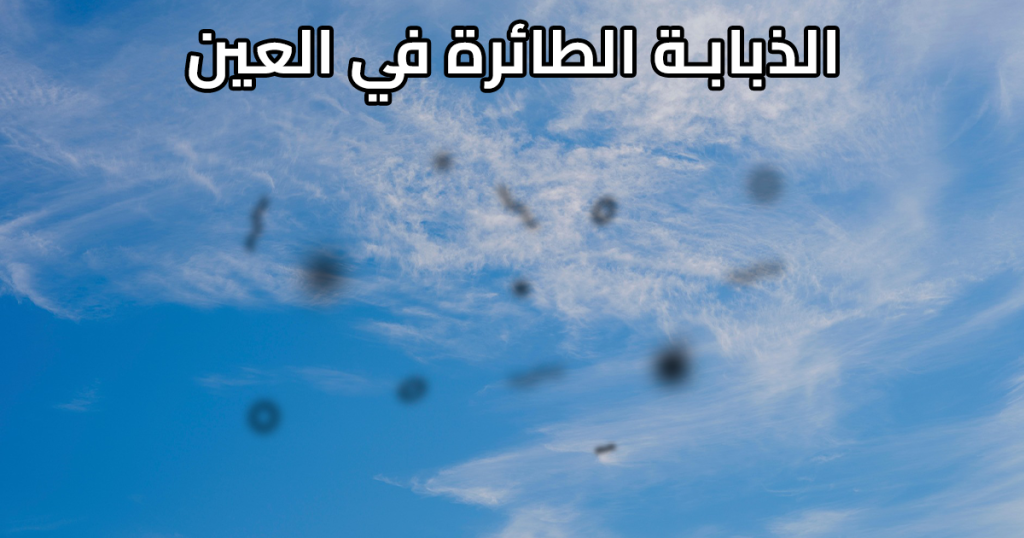الذبابة الطائرة في العين .. أسبابها وأعراضها وعلاجها، وهل هي خطيرة؟
